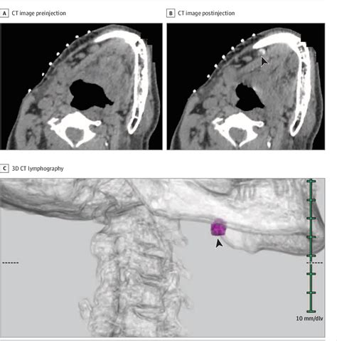 Figure 1 From Sentinel Lymph Node Biopsy Using Preoperative Computed