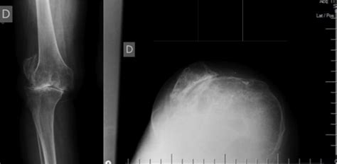 Scielo Brasil Total Knee Arthroplasty In Patients With Permanent