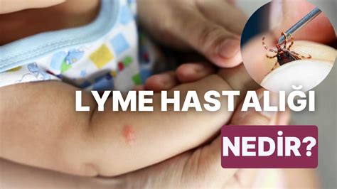 Lyme Hastal Nedir Lyme Hastal N N Belirtileri Nelerdir Nas L