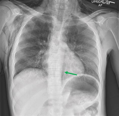 Ct Esophagography For Evaluation Of Esophageal Perforation Radiographics