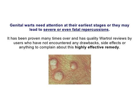 Stages Of Genital Warts