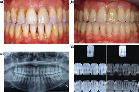 Periodontal Considerations In Adult Orthodontic Patients Intechopen