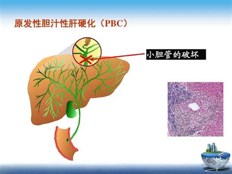 原发性胆汁性肝硬化和原发性硬化性胆管炎病人在等待肝移植期向要注意哪些再造人