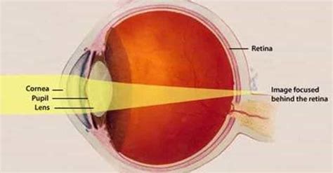 Keratoconus Symptoms | List of Signs of Keratoconus