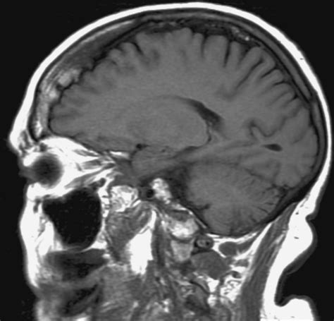 Hyperostosis Frontalis Interna Pacs