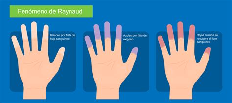 Recomendaciones Para El Uso De La Capilaroscopia En El Fenómeno De Raynaud Según La Reumatología