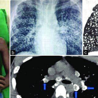 Egg Shell Calcification Seen In The Mediastinal And Hilar Lymph Nodes