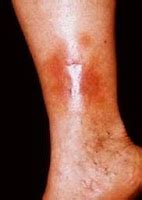 stasis dermatitis causes, symptoms, and treatment | Share All Knowledge