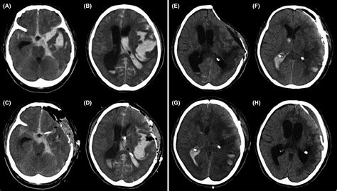 Unexpected Complications Immediately After Cranioplasty Kato 2017 Acute Medicine And Surgery