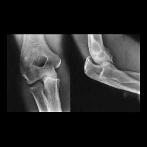 Recurrent And Chronic Elbow Instability Dr Gustavo Armando Tafoya