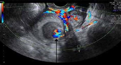 Doppler Ultrasound Shows Mixed Av Waveform With Aliasing Of Colour Download Scientific Diagram