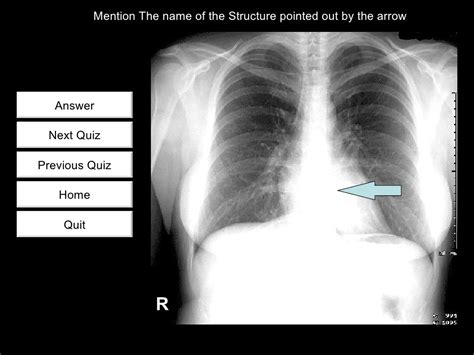 Chest Radiology Quiz