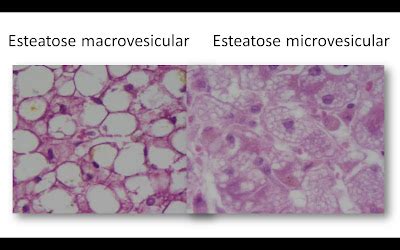 Patologia Básica Fígado normal e esteatose macro e microvesiculares