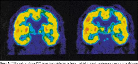 Figure 2 From A Case With Corticobasal Degeneration Showing Asymmetric Apraxia With Concordant