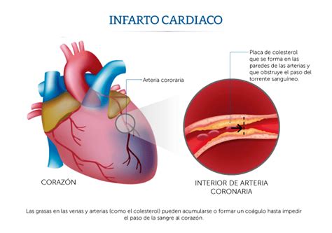 Médica Sur Qué es un infarto cardiaco