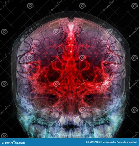 3D Rendered Medically Accurate Illustration Of The Cerebral Artery Of