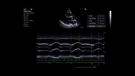 Acuson Juniper Cv Edition Ultrasound System Siemens Healthineers