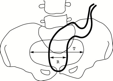 megarectum  constipation archives  disease  childhood