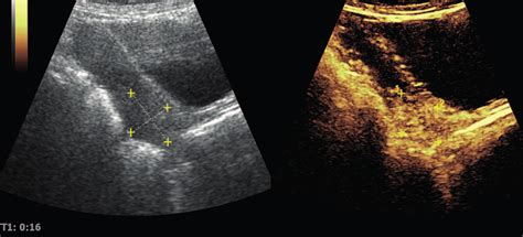 The Enhanced Pattern By Contrast Enhanced Ultrasound Ceus Displayed