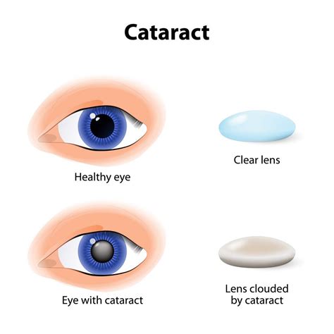 Risk Factors Of Cataract Risk Factors Associated With Cataracts… By Digital Medium