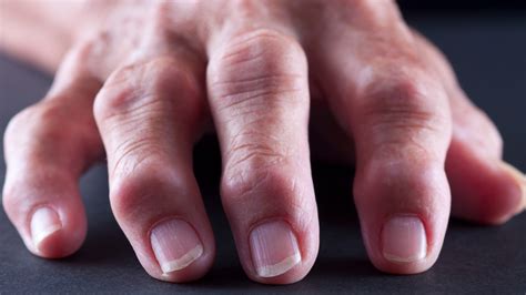 Finger Joint Pain - Symptoms, Causes, Diagnosis, Treatment | Diseases Pictures