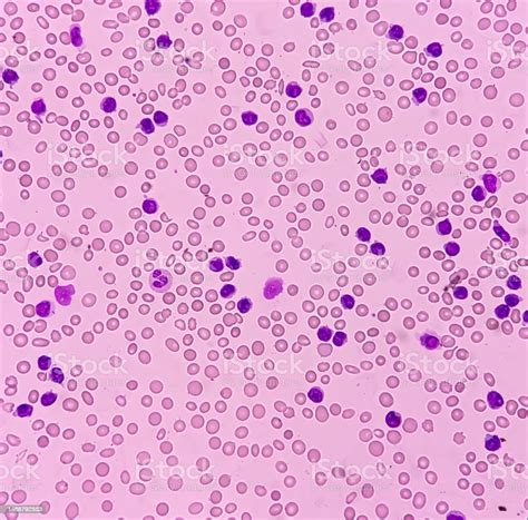 Lymphocytosis With Thrombocytopenia Smear Show White Blood Cells And ...