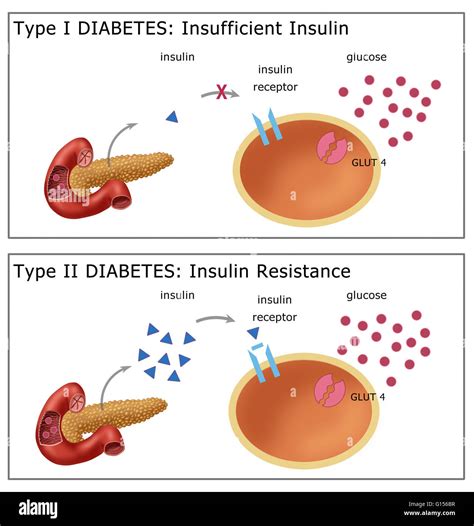 Ilustraci N Comparando La Diabetes Tipo I Arriba Donde El Cuerpo No