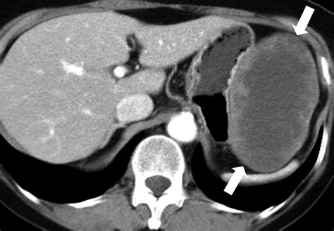 Gastrointestinal Stromal Tumors Of The Stomach Ct Findings And