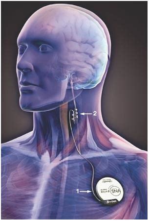 Vagal Nerve Stimulators Questions And Answers In MRI