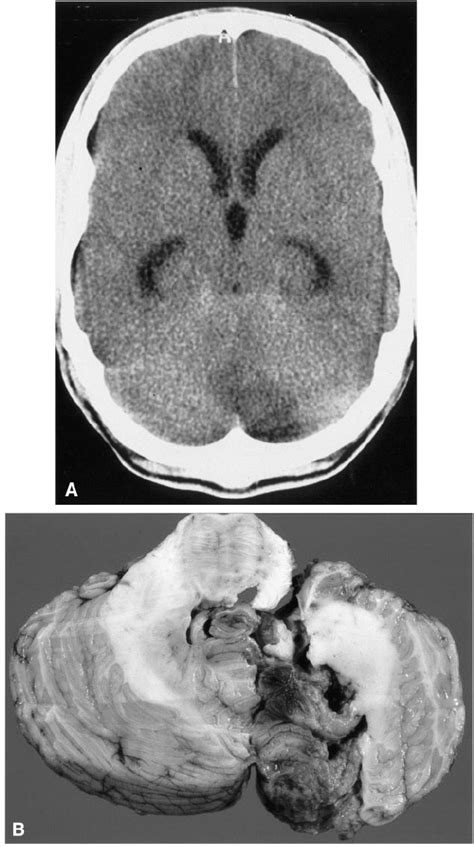 A Ct Of The Head Of Patient 2 Demon Strating Hypodensity In Left