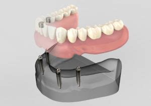 full-arch-dental-implants-mode; – The Facial & Oral Surgery Center