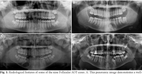 Figure 2 From Adenomatoid Odontogenic Tumor Case Series Of 14 With