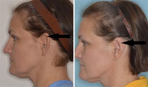 Otoplasty Photos | Miami, FL | Patient 1365