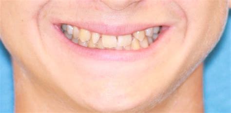 Missing And Peg Lateral Incisors Alexandria Virginia