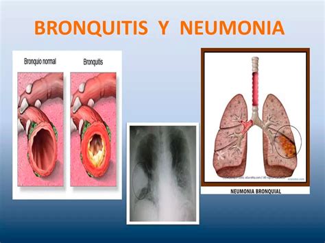 Síntomas de una bronquitis o neumonía Más información