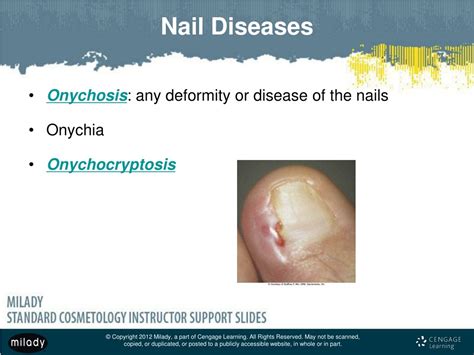 PPT - Chapter 10 Nail Disorders and Diseases PowerPoint Presentation