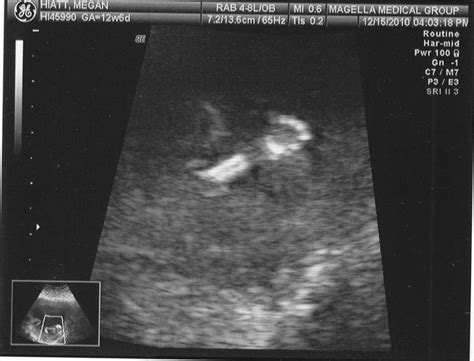 The Spamdrew Family: 13 Week Ultrasound