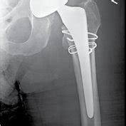 Pdf Early Intraprosthetic Dislocation Of Dual Mobility Total Hip