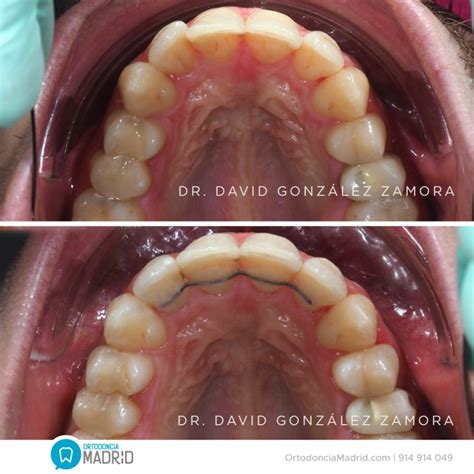 Sobremordida Y Apiñamiento • Ortodoncia Madrid