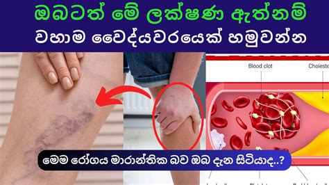 ඔබටත් මේ ලක්ෂණ ඇත්නම් ප්‍රමාද නොකර වහාම වෛද්‍යවරයෙක් හමුවන්න Youtube