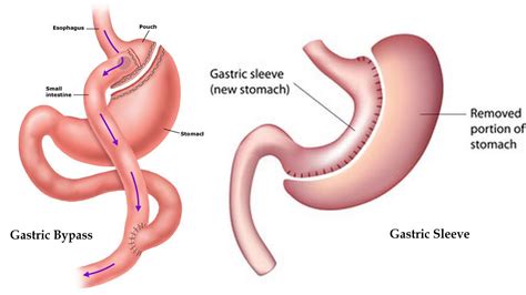 Roux En Y Gastric Bypass Vs Vertical Sleeve Gastrectomy Which Did You