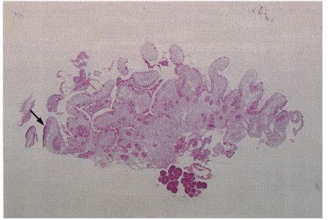 Biopsy Taken From The Duodenal Bulb In A Patient With A Duodenal Ulcer