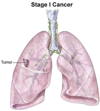 Cancer: Stages Of Lung Cancer