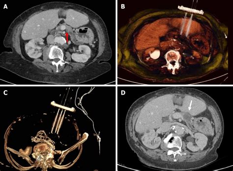 Current Status Of Non Surgical Treatment Of Locally Advanced Pancreatic