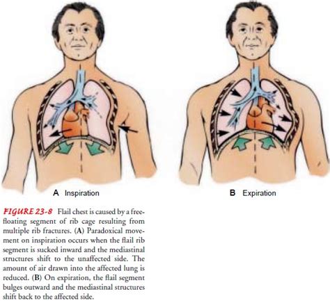 Flail Chest Diagram