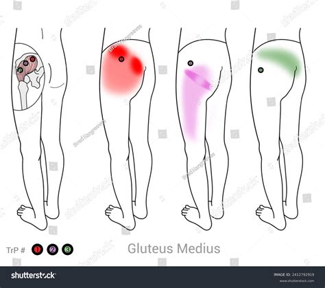 Myofascial Trigger Point Gluteus Medius Muscle Stock Illustration