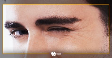 Lifting O Implante De Cejas Elige Correctamente Capilar Center