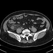 Viewing Playlist Abdomen Ct Radiopaedia Org