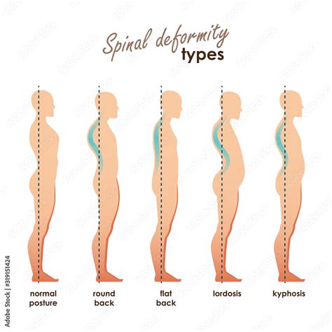 Spinal deformity types. Diseases of the spine.Lordosis, kyphosis, round back, flat back. Vector ...