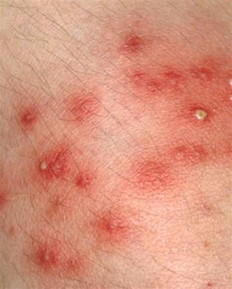 Mrsa Symptoms